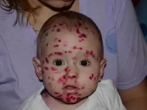 Так выглядит фукорцин на коже у ребенка